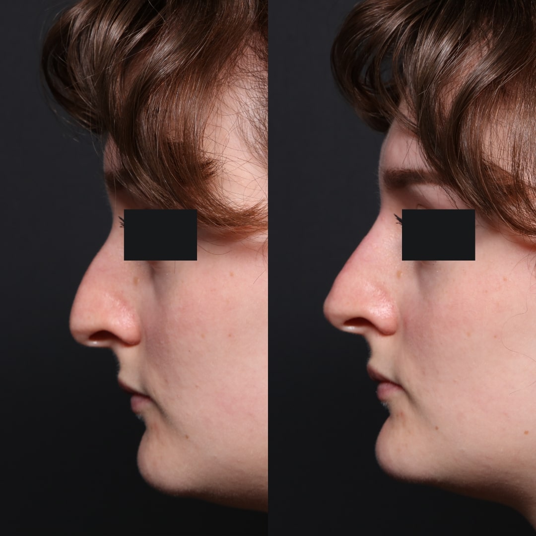 Non surgical rhinoplasty before and after