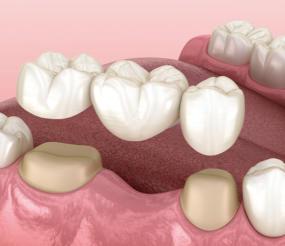 Crowns and bridges from Define Clinic in Beaconsfield and London. Restoring Your Smile With Crowns and Bridges