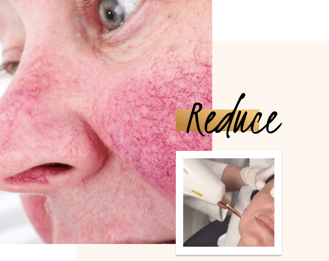 Facial Redness Treatment With Ipl Lasers At Define Medical Clinic