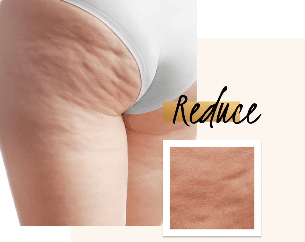 Fight back against cellulite with - Bioflect Medical