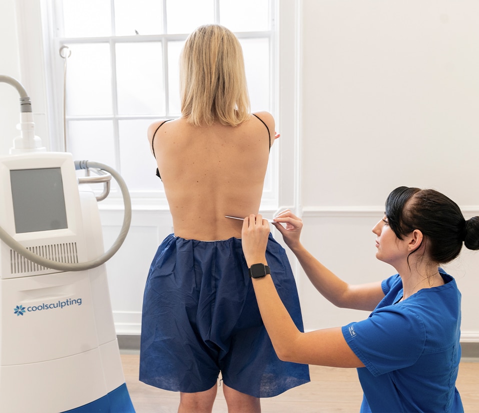 CoolSculpting Fat Freezing Back Fat London