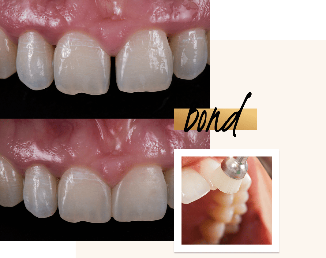 Dental Bonding Resin 