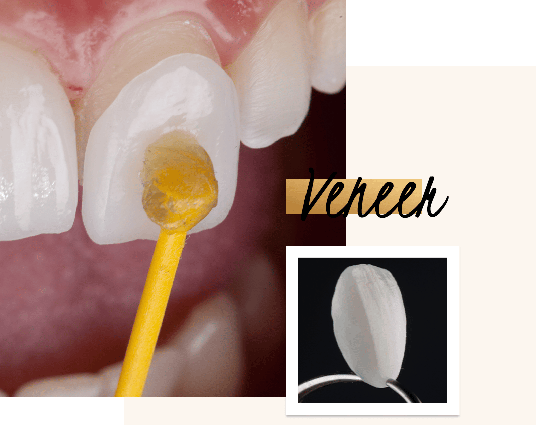 Porcelain veneers are the secret behind many Hollywood and A-list smiles, and the number-one treatment for creating perfect teeth of uniform shape, colour and proportions.