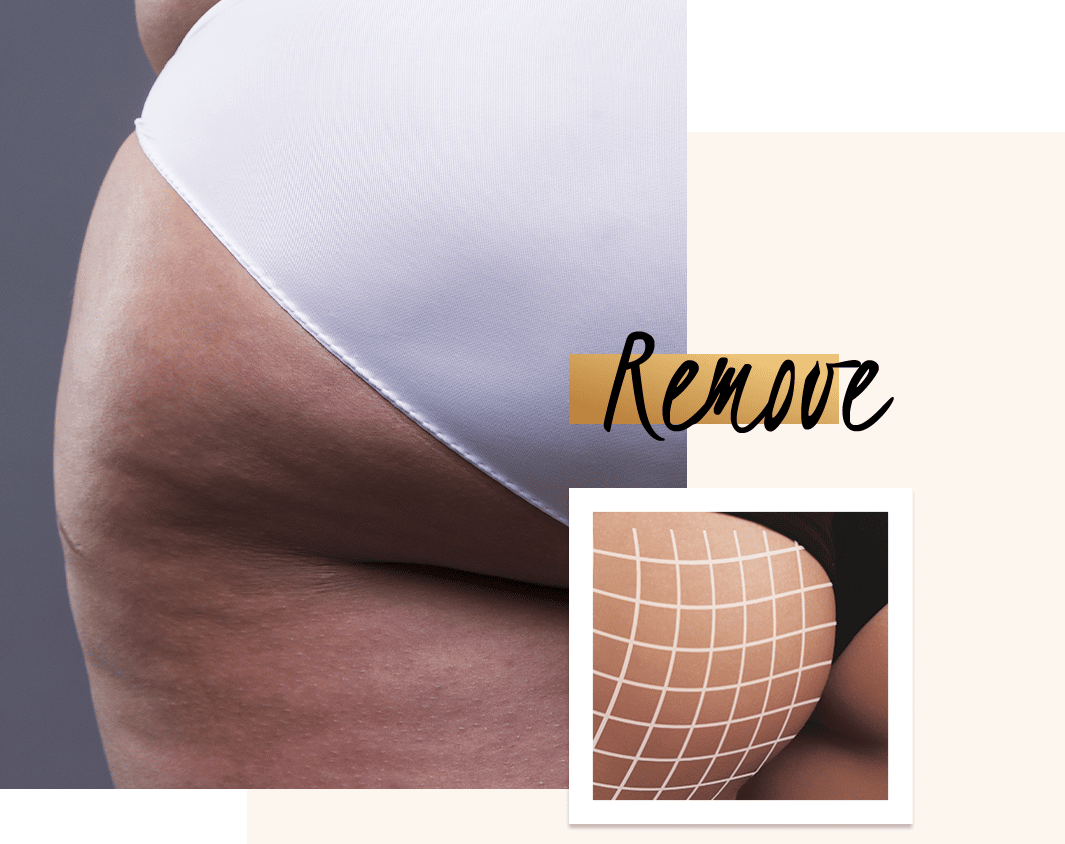 Banana Roll Butt Fat Removal With Coolsculpting