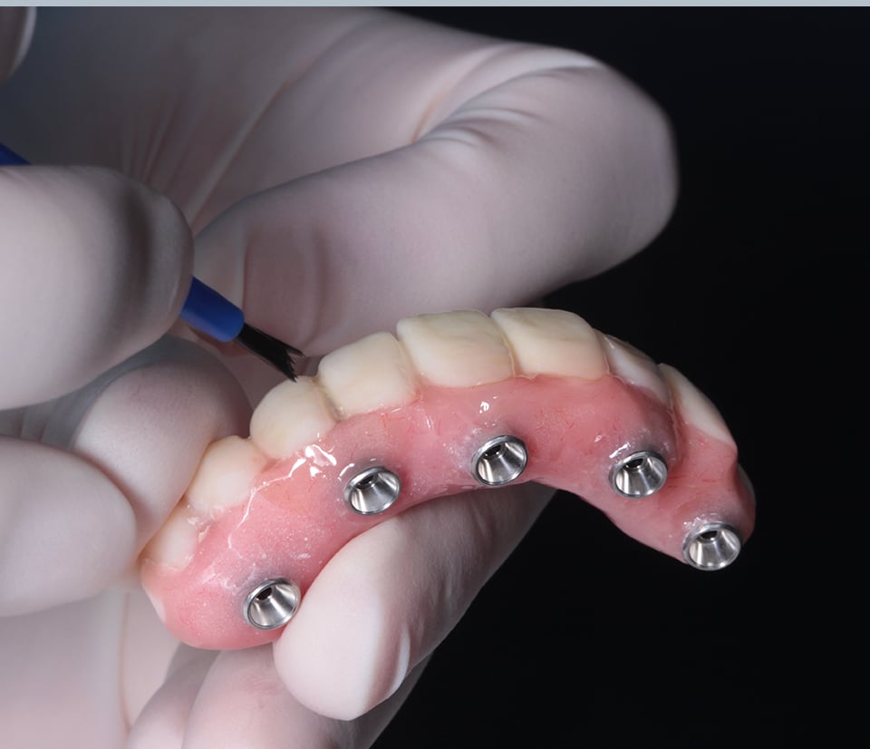 How do dental implants work?