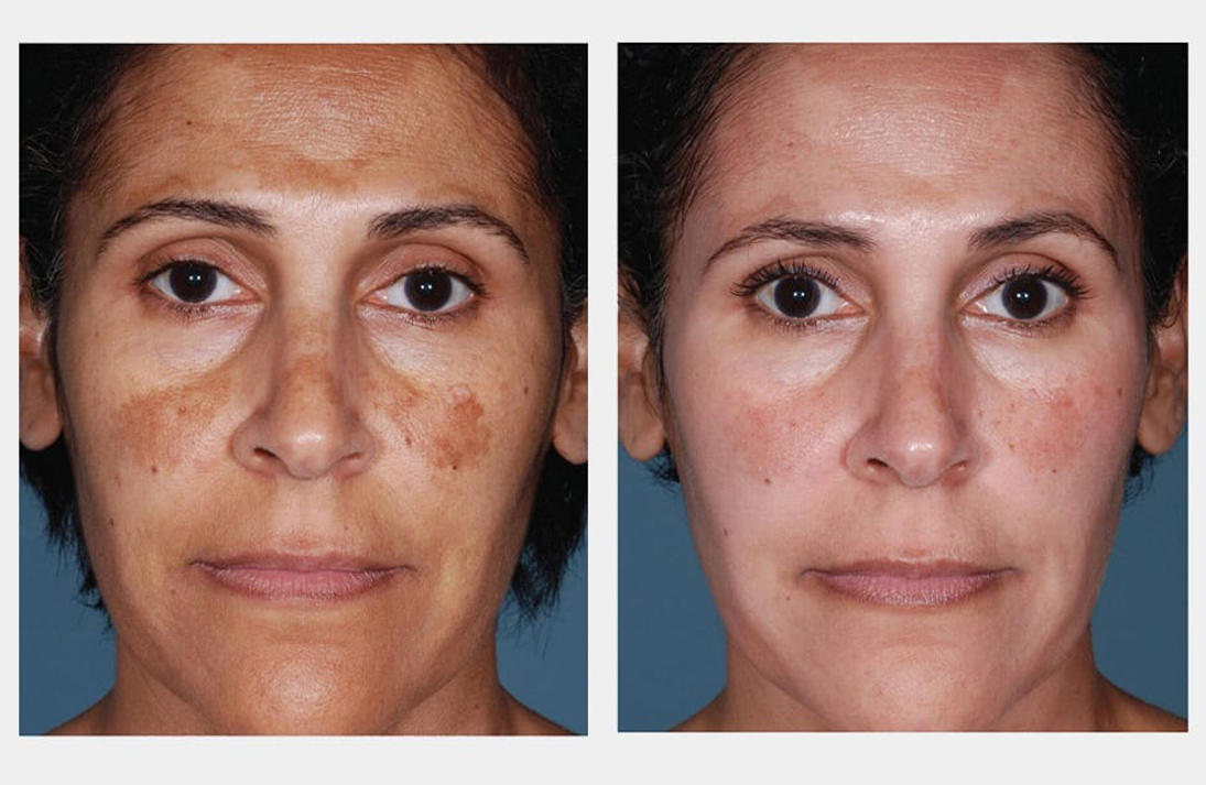 Treating pigmentation issues