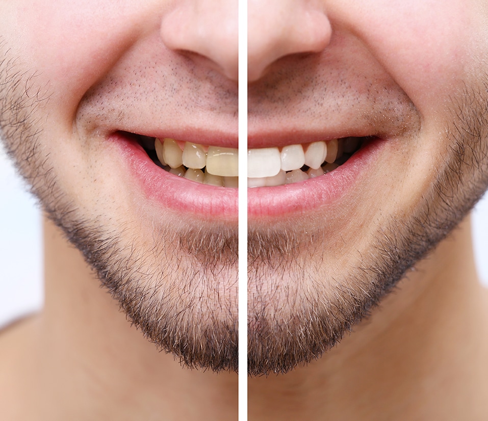 Teeth whitening before and after by Define clinic Beaconsfield and London