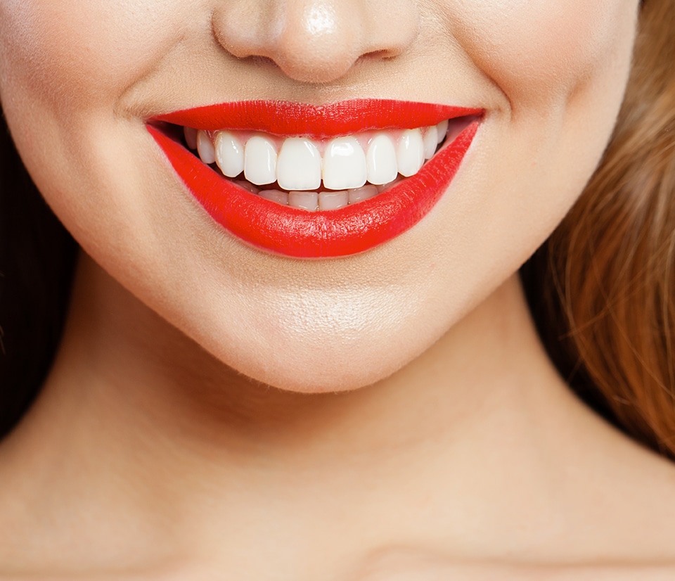 Teeth whitening by Define Clinic Dentistry London & Beaconsfield