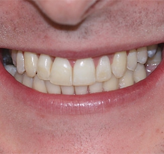 Invisalign Clear Braces Treatment for Crowded Teeth - Define Clinic London  & Beaconsfield