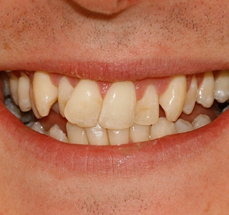 Invisalign Clear Braces Treatment for Crowded Teeth - Define Clinic London  & Beaconsfield