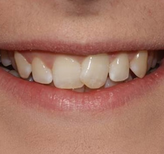 Invisalign Clear Braces Treatment for Crowded Teeth - Define Clinic London  & Beaconsfield