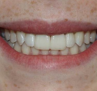 Invisalign Clear Braces Treatment for Crowded Teeth - Define Clinic London  & Beaconsfield