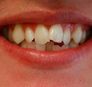 Invisalign Braces for a beautiful smile - Define Clinic