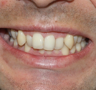 Invisalign Clear Braces Treatment for Crowded Teeth - Define Clinic London  & Beaconsfield