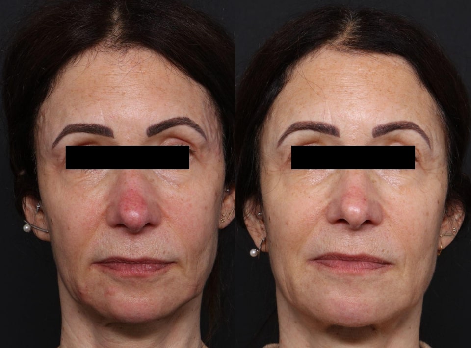 BBL Sciton before and after