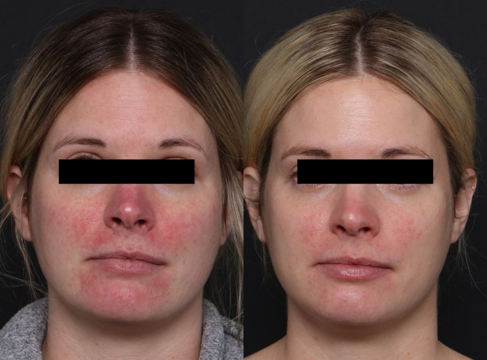 BBL Sciton before and after