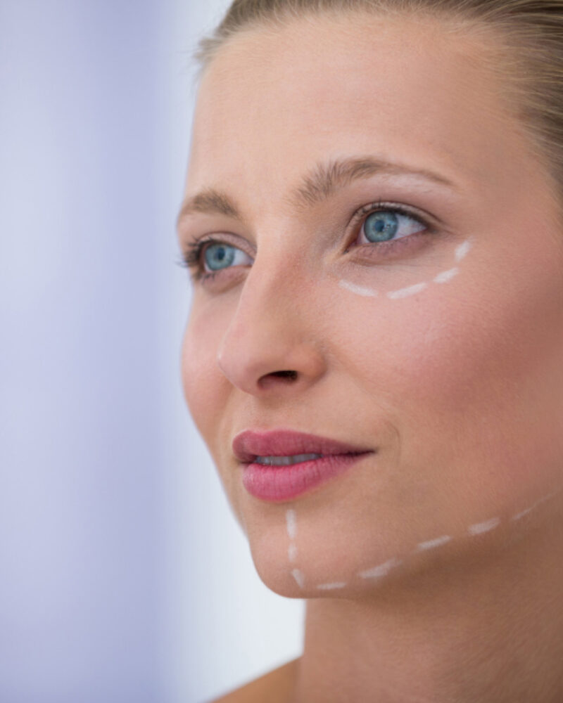 What Tear Trough Filler London Can & Can’t Do