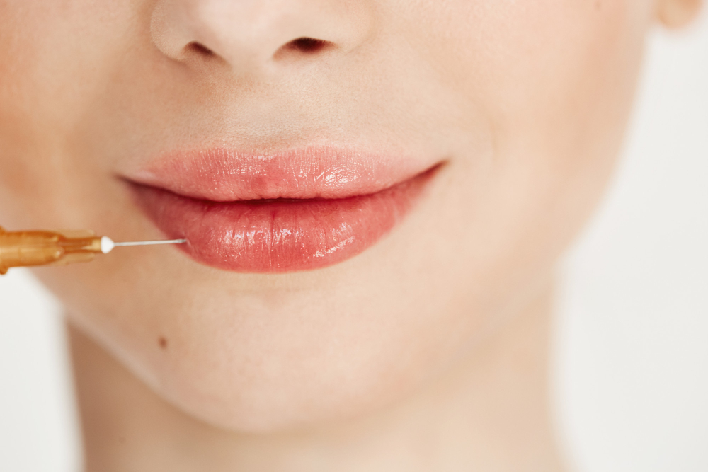 london lip fillers