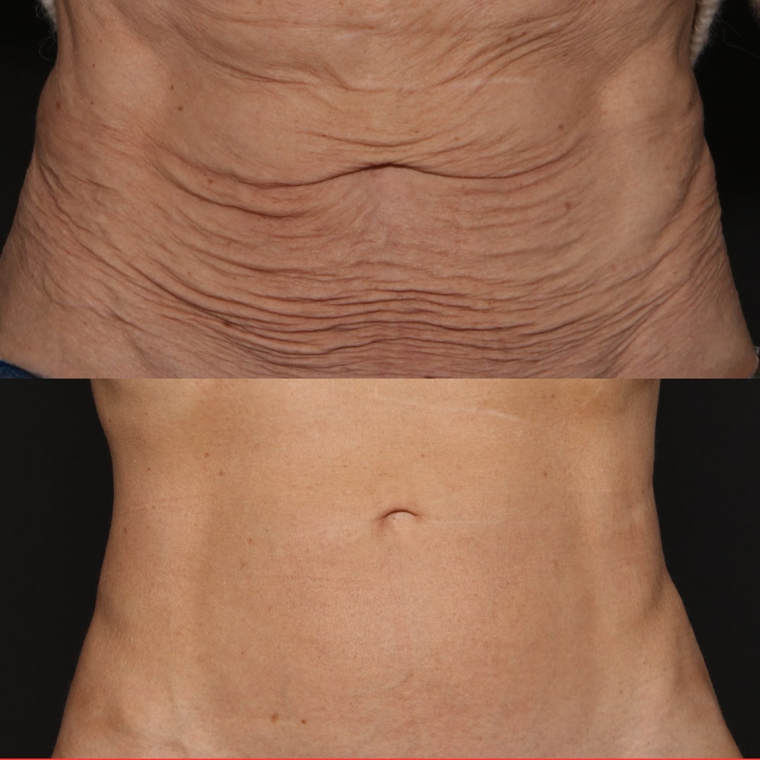 Ultraformer on the abdomen before and after
