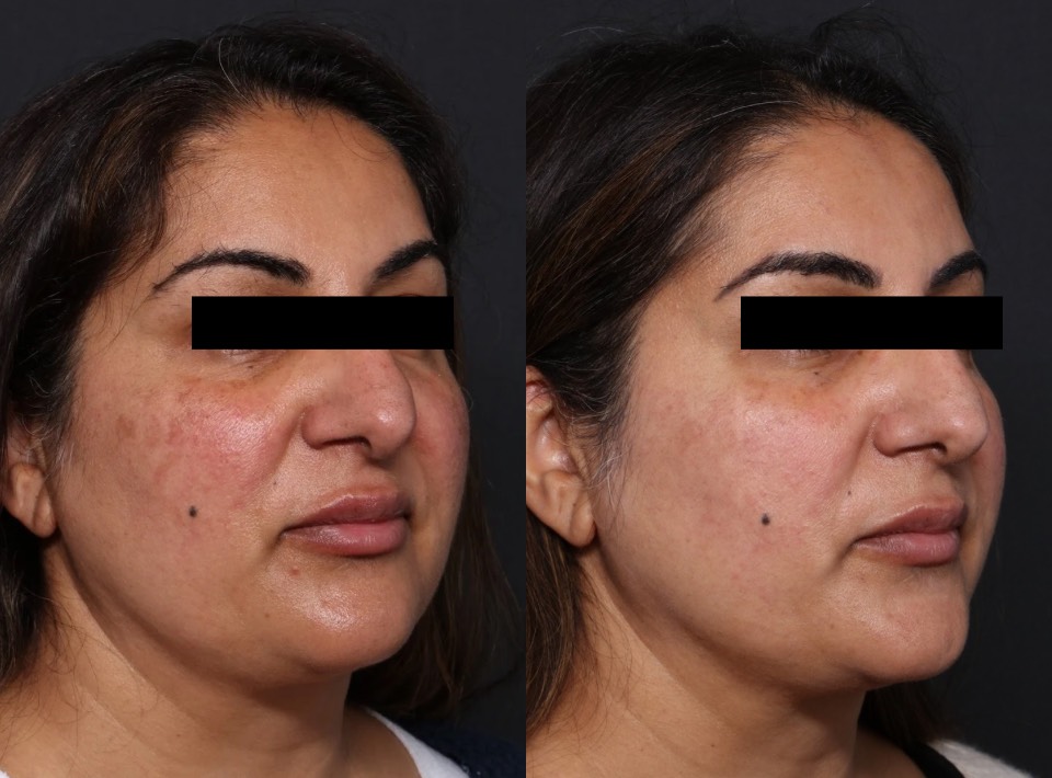 BBL Hero & Halo before and after for pigmentation on face