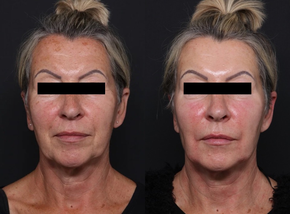 BBL Hero & Halo before and after for pigmentation on face