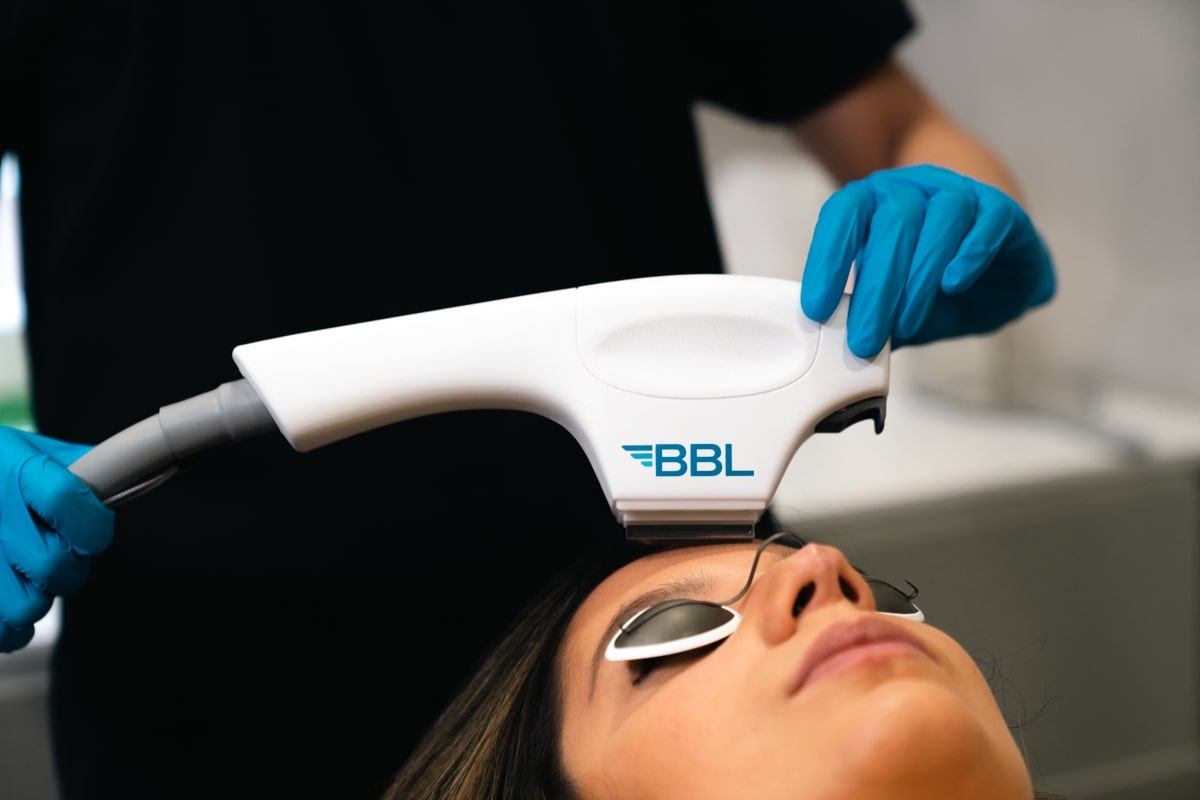 BBL Sciton treatment