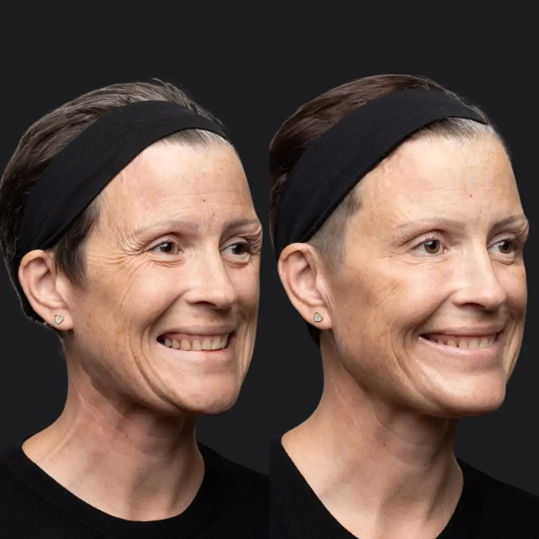 Botox London before and after face