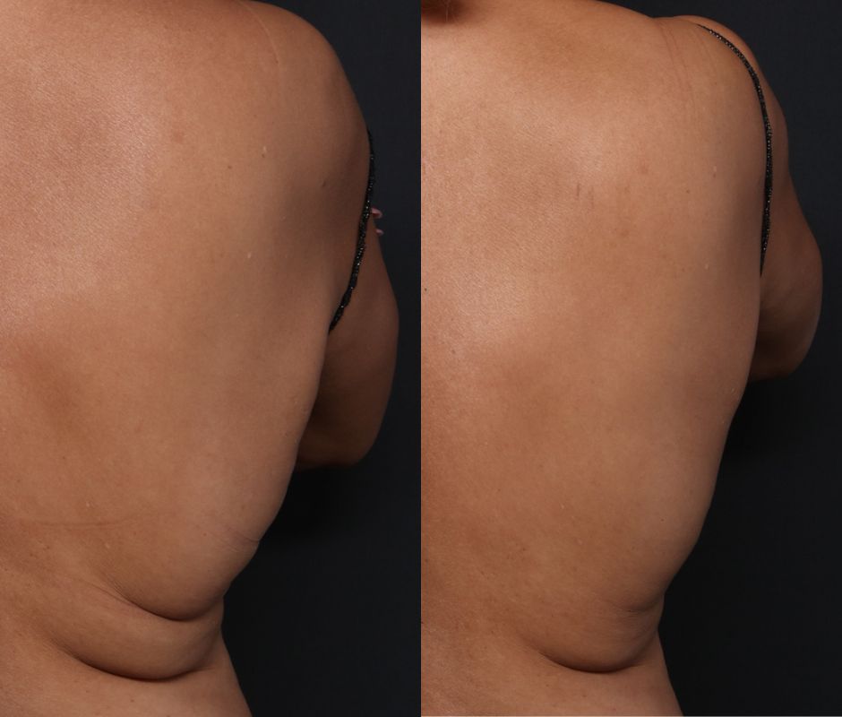 Coolsculpting back fat before and after