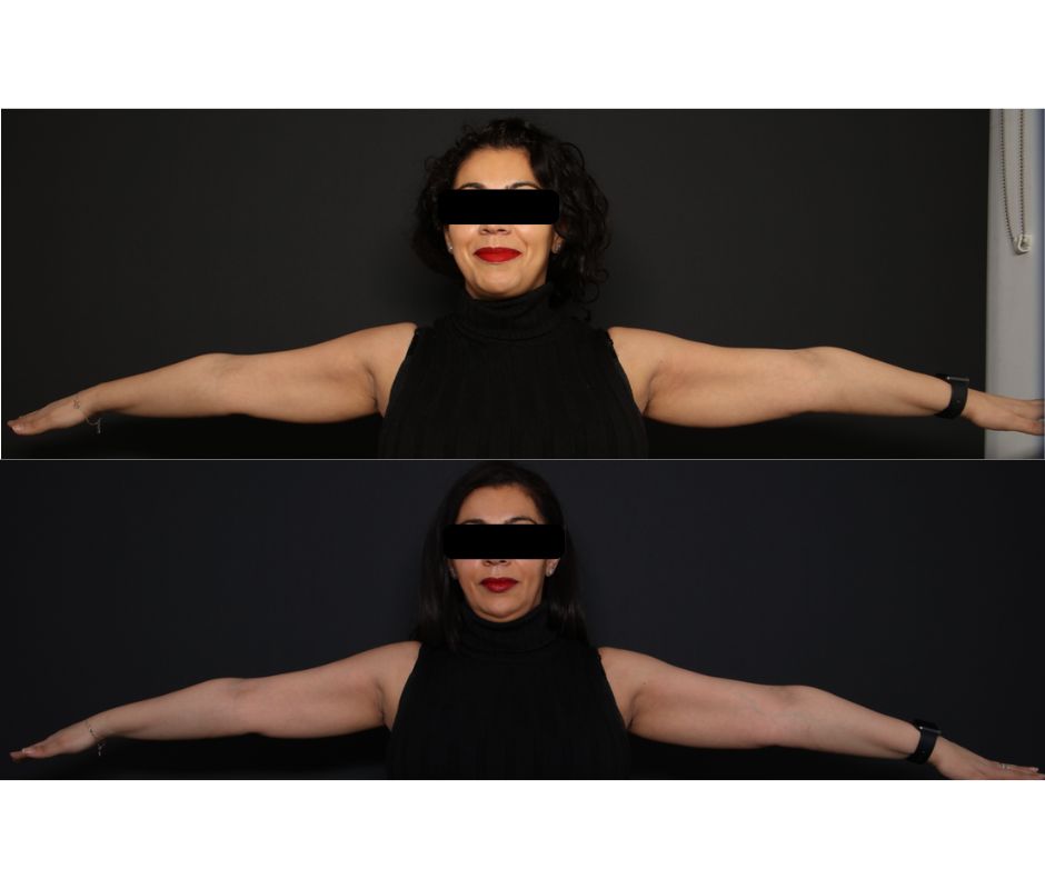 Coolsculpting under arms before and after