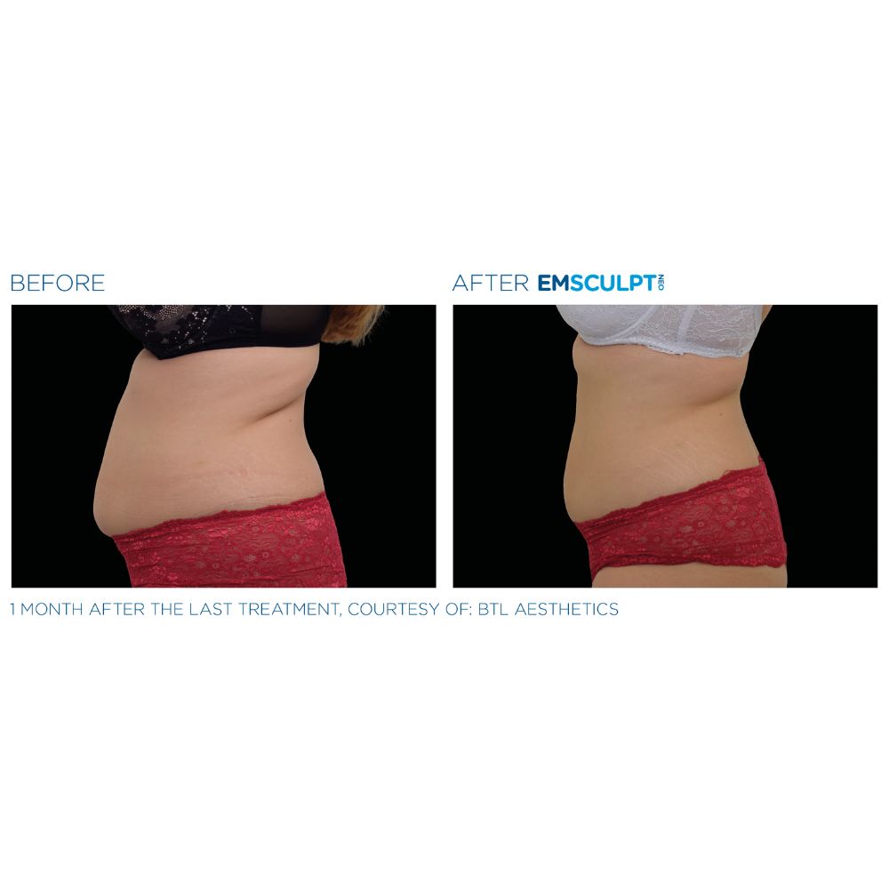 Emsculpt Neo before and after abdomen