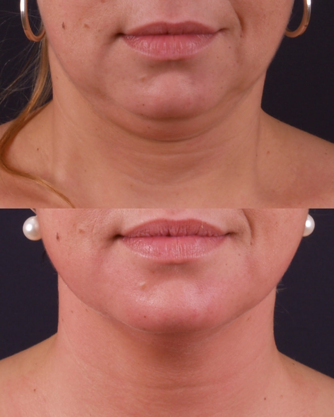 Exilis before and after jawline and chin