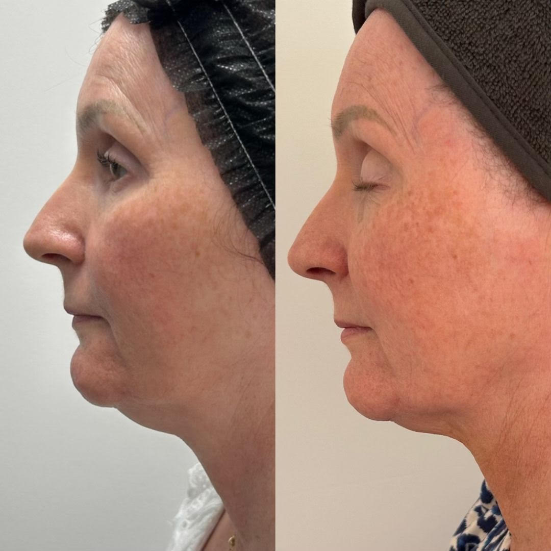 HIFU before and after face