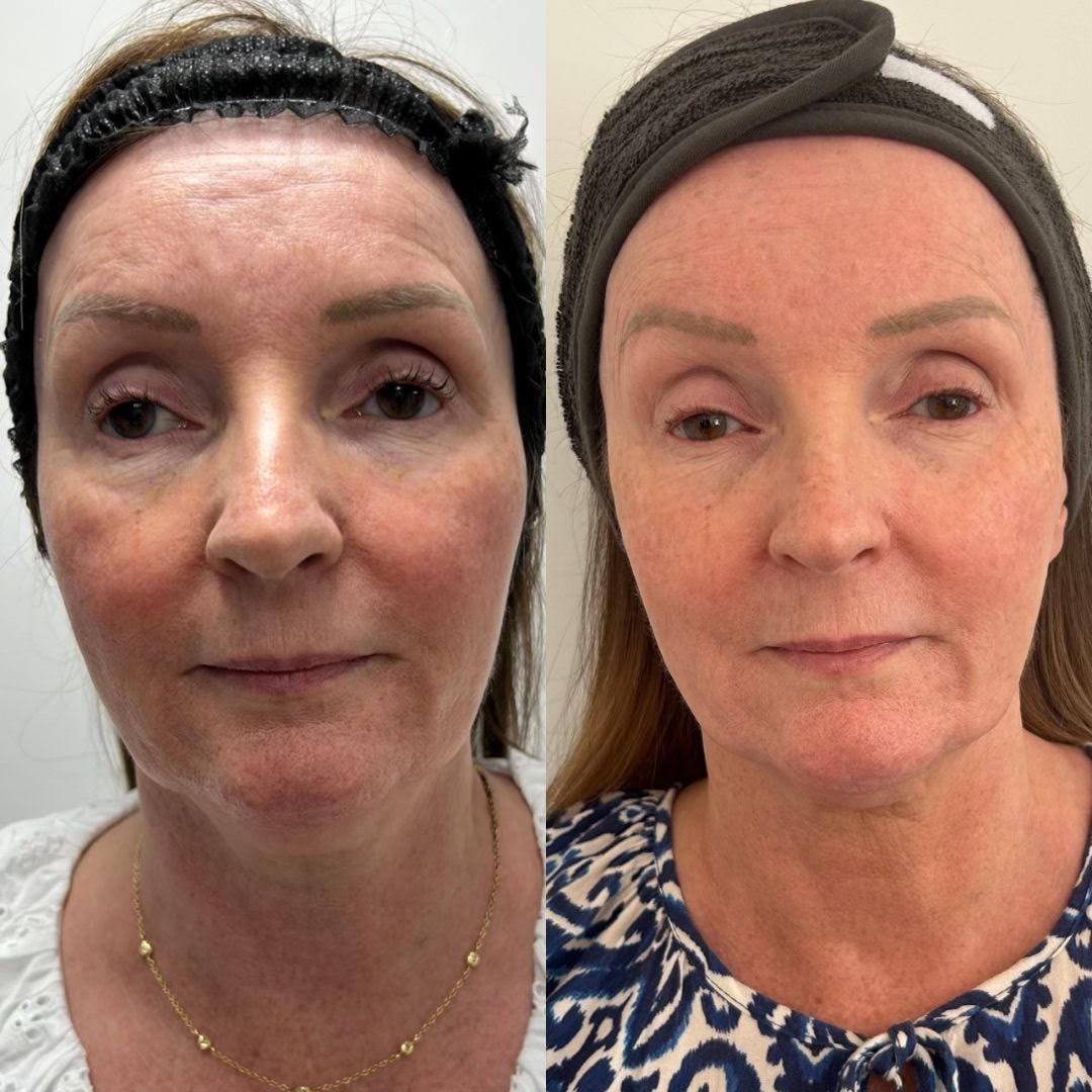 HIFU before and after face