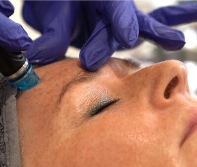 HydraFacial treatment