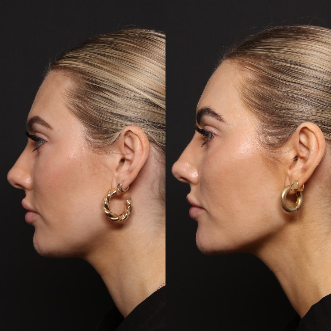 Ultraformer before and after