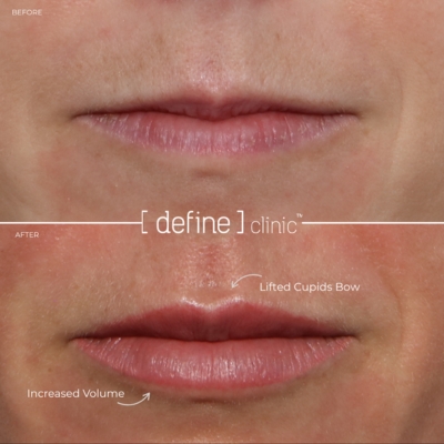 Lip flip before and after at Define Clinic