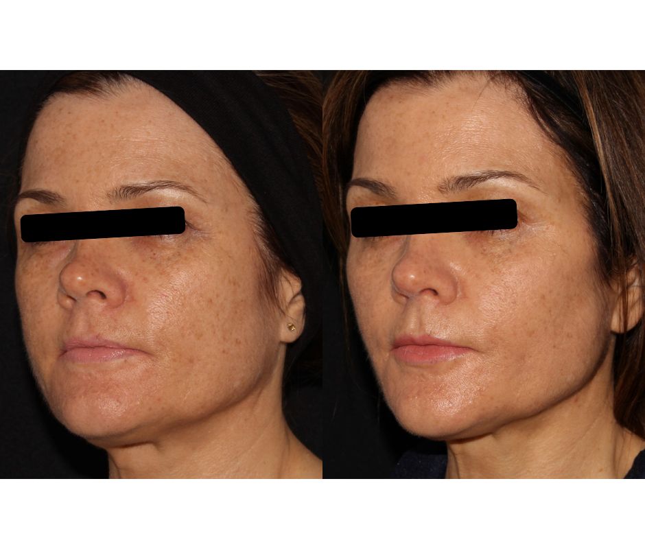 Liquid facelift before and after