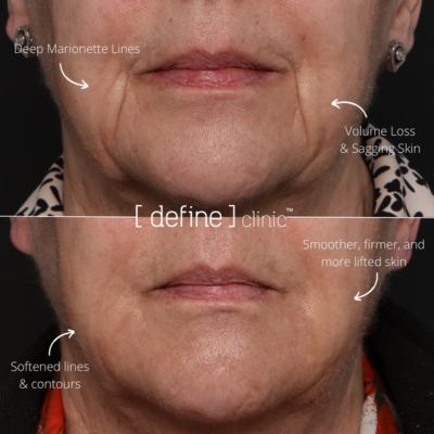 Dermal fillers marionette lines before and after