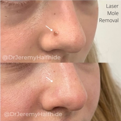 Laser Mole removal before and after
