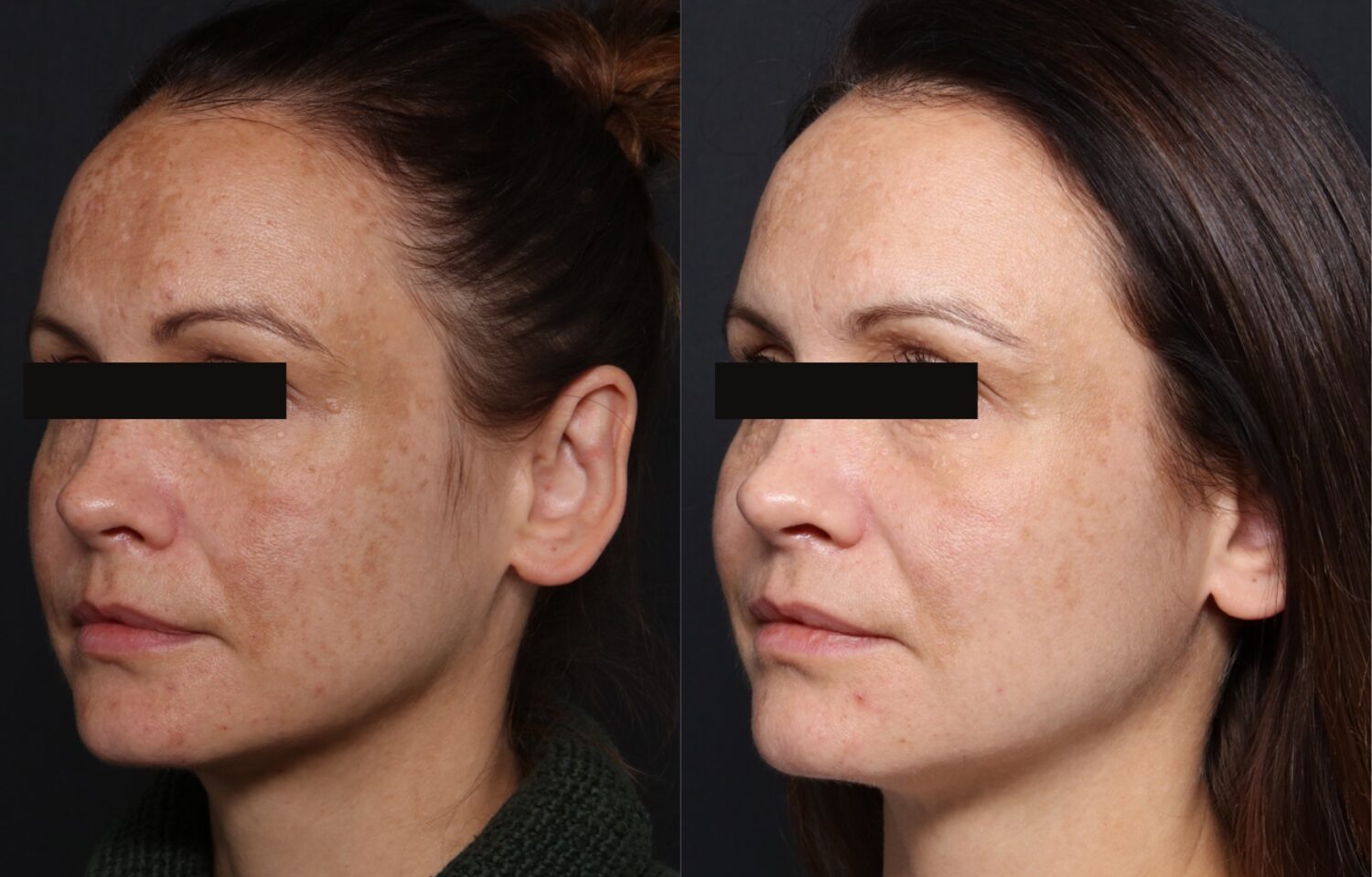 BBL Hero & Halo before and after for pigmentation on face