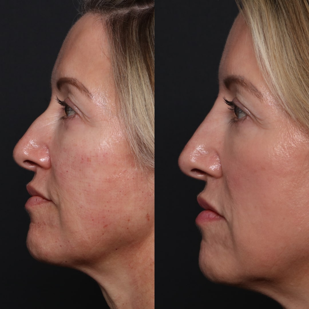 Non surgical rhinoplasty before and after