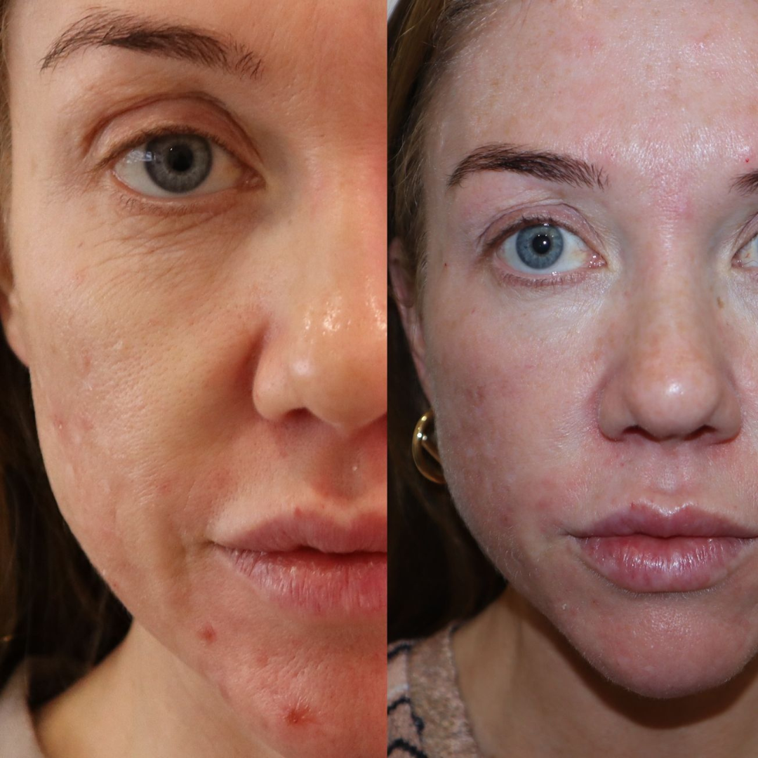 Polynucleotides before & after acne