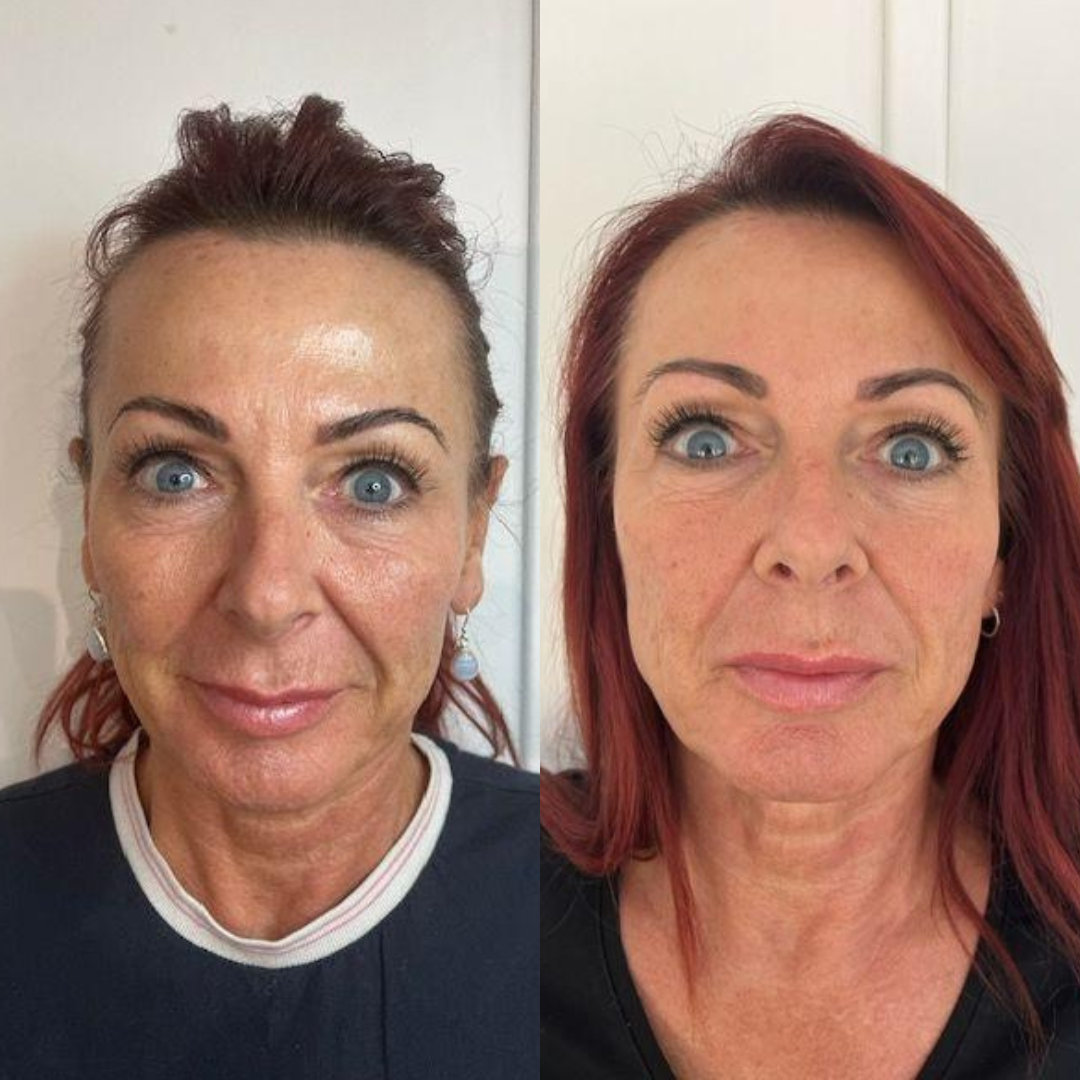 Polynucleotides before & after full face