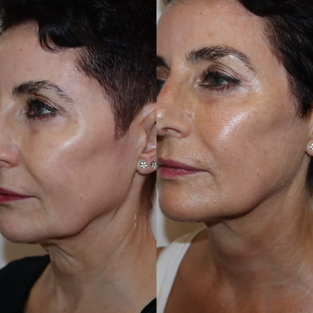 Polynucleotides before & after neck and jawline