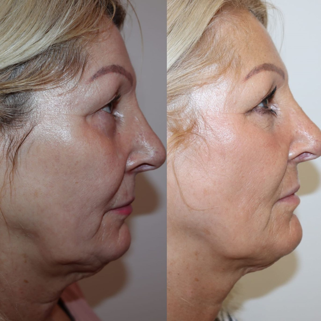 Polynucleotides before & after neck and jawline