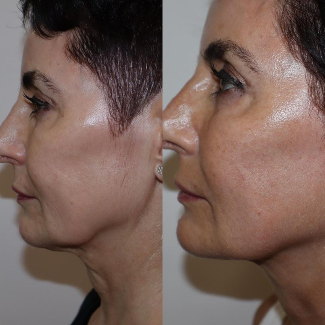 Polynucleotides before & after neck and jawline