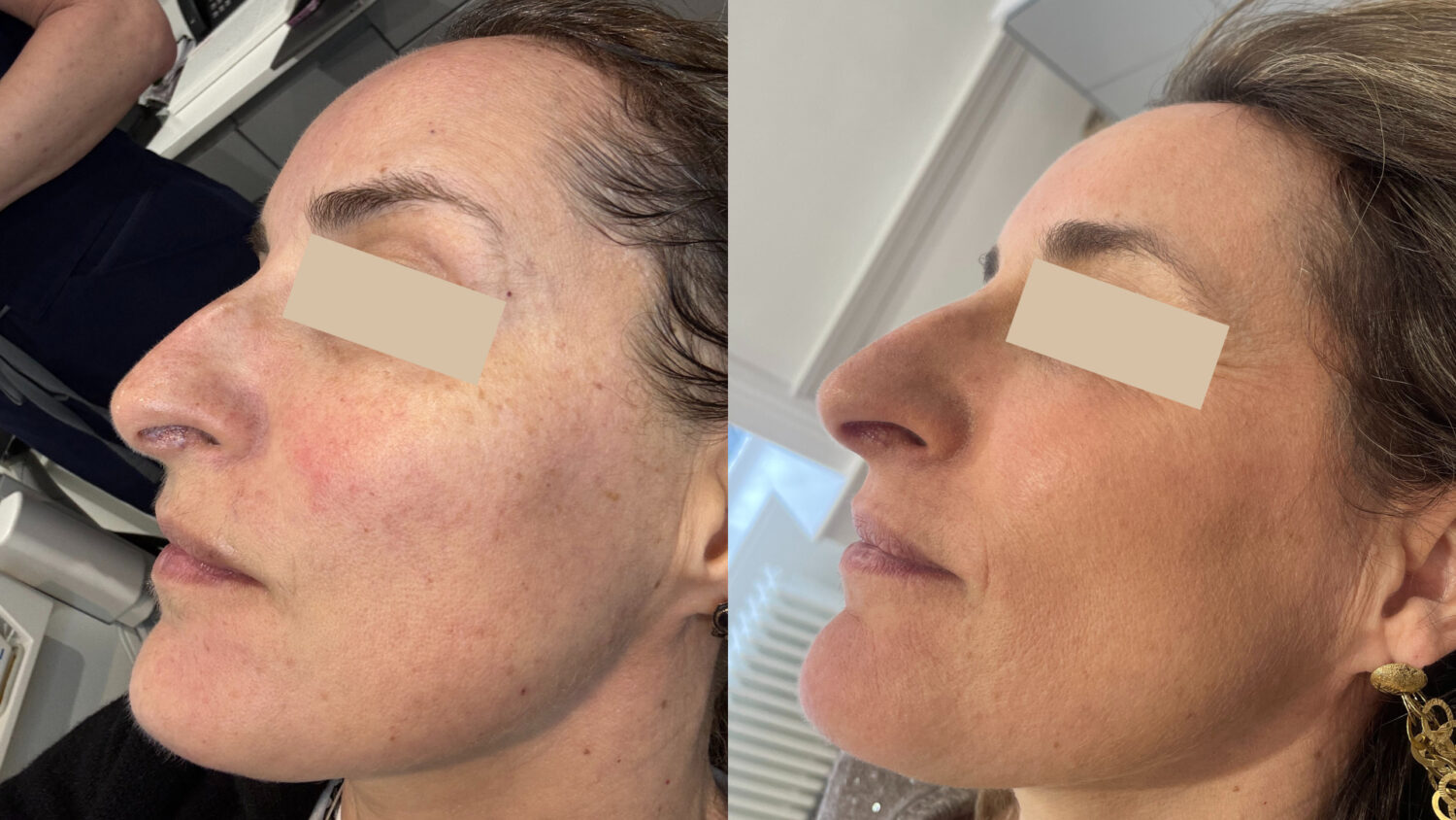 BBL Sciton before and after results on face for even skin tone