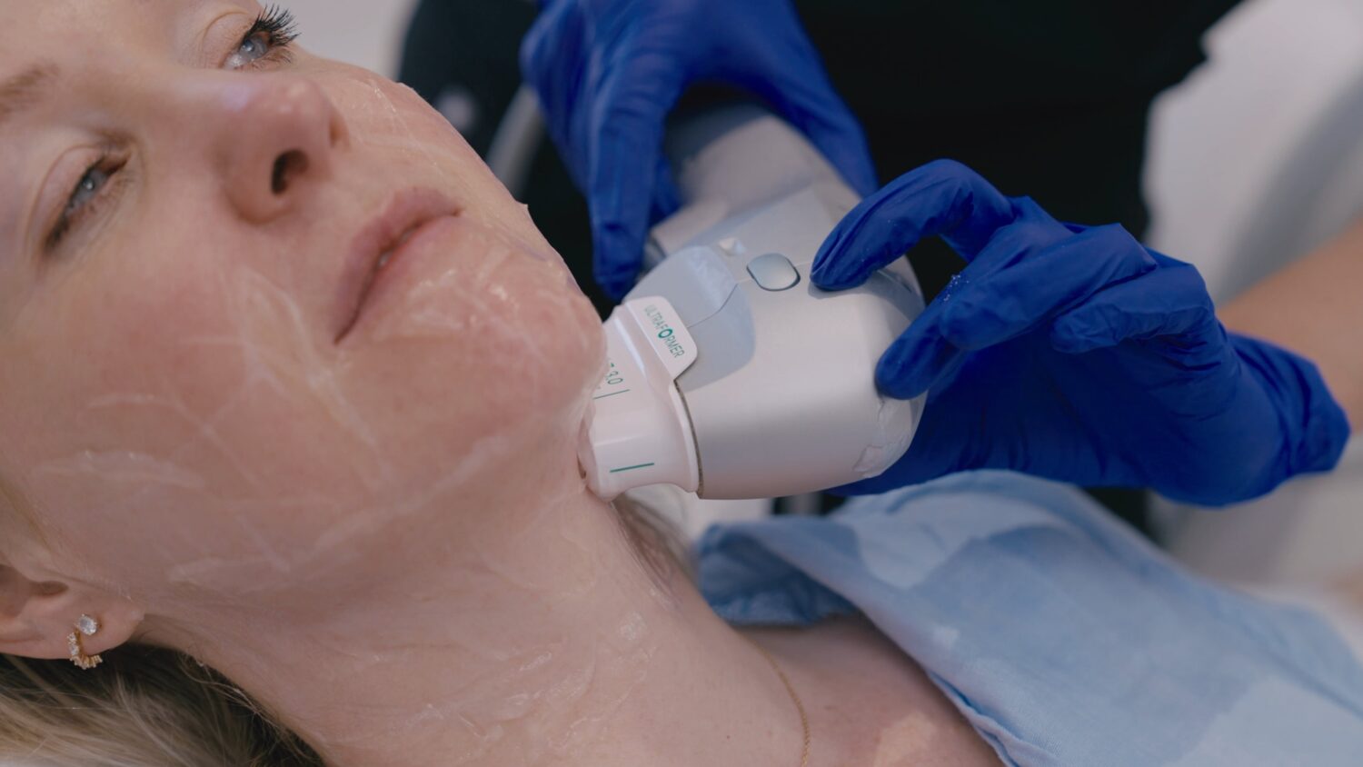 Ultraformer treatment