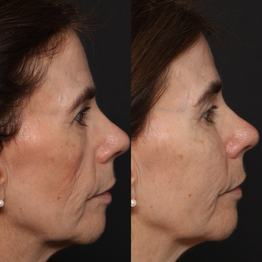 Cheek dermal filler before and after