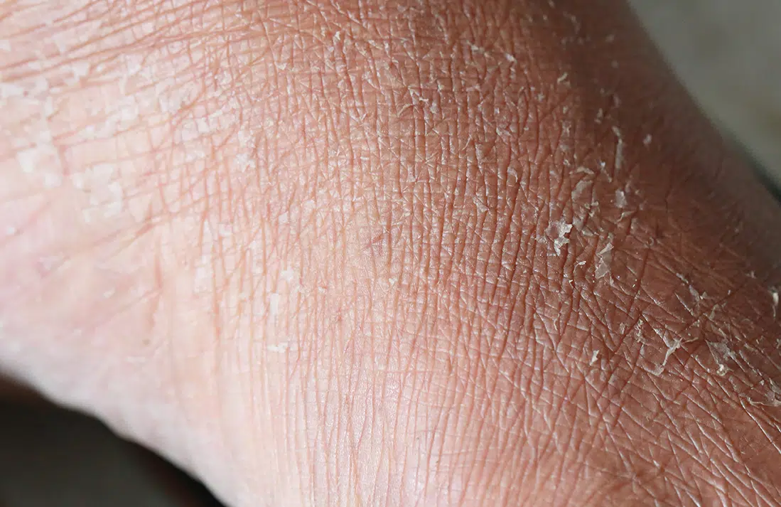 Dehydrated Skin and Dull Skin